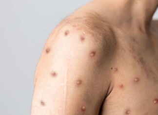 Brasil contabiliza 1,5 mil casos de mpox em 2024