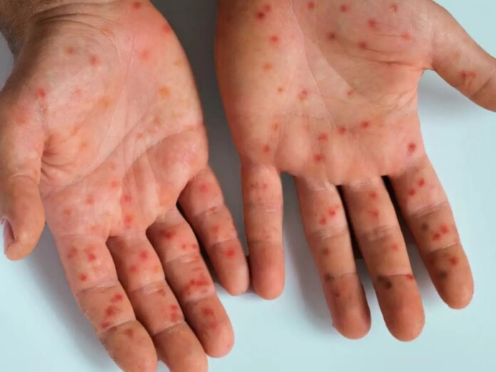 759004198-mpox-sintomas-tratamento
