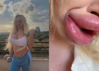 Influenciadora enfrenta problemas para fechar a boca após procedimentos estéticos