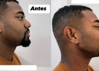 Davi Brito passa por lipo, faz harmonização facial e coloca lentes nos dentes em nova fase