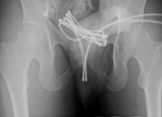 Cabo USB fica preso no pênis durante ato sexual e homem é hospitalizado