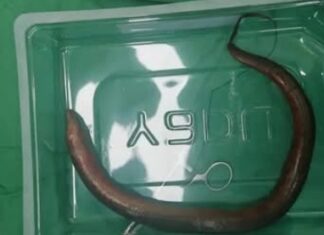 Médicos encontram enguia viva ‘nadando’ no abdômen de paciente chinês