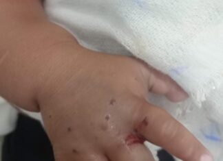 Após ser picado por cobra, bebê é removido de Maués para hospital em Manaus