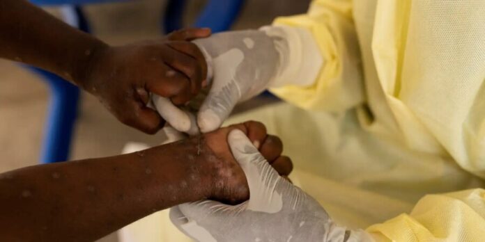 Brasil registra 88 casos de Mpox em 2026; São Paulo lidera com 62 infecções