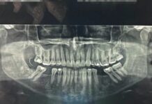 Paciente passa 10 dias com agulha na gengiva após extração de dente