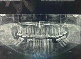 Paciente passa 10 dias com agulha na gengiva após extração de dente
