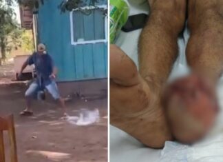 Homem tenta pisar em ‘catolé’ para conter explosão e sofre grave ferimento no pé