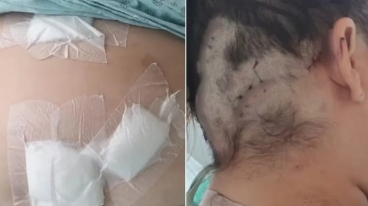Mulher é mantida em cárcere, t0rturada e atingid@ pelo ex com 12 facad@s: ‘fingi que estava m0rta’